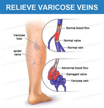 Lade das Bild in den Galerie-Viewer, Leistungs starke Laser therapie bei mäßigen Krampfadern, lindert Schmerzen und verbessert die Durchblutung von Männern und Frauen
